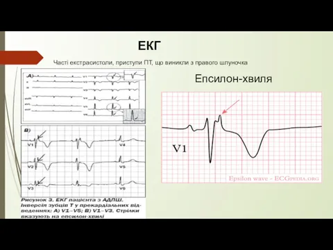 Епсилон-хвиля ЕКГ Часті екстрасистоли, приступи ПТ, що виникли з правого шлуночка