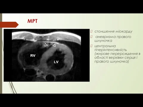 МРТ стоншення міокарду аневризма правого шлуночка центральна гіперінтенсивність (жирове перерождення