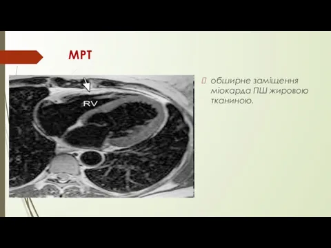 МРТ обширне заміщення міокарда ПШ жировою тканиною.