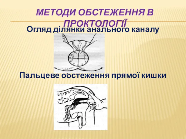 МЕТОДИ ОБСТЕЖЕННЯ В ПРОКТОЛОГІЇ Огляд ділянки анального каналу Пальцеве обстеження прямої кишки