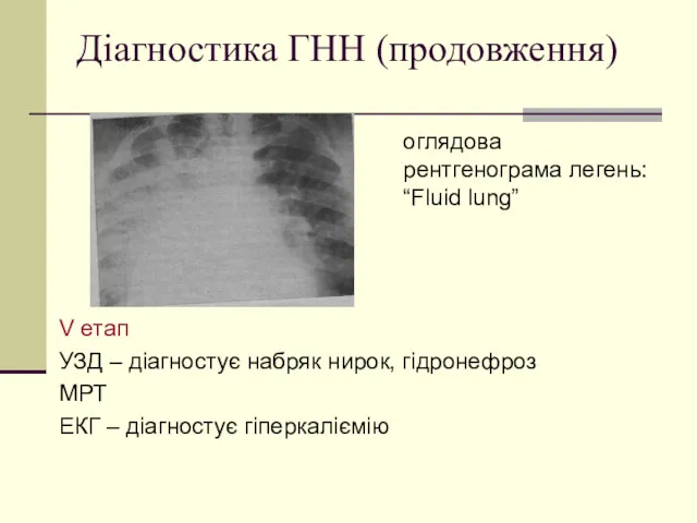 Діагностика ГНН (продовження) V етап УЗД – діагностує набряк нирок,