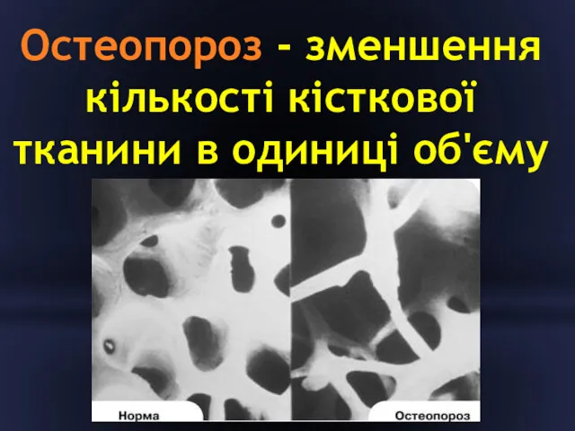 Остеопороз - зменшення кількості кісткової тканини в одиниці об'єму