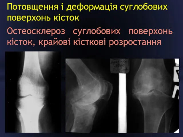 Потовщення і деформація суглобових поверхонь кісток Остеосклероз суглобових поверхонь кісток, крайові кісткові розростання