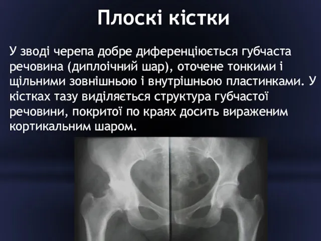 Плоскі кістки У зводі черепа добре диференціюється губчаста речовина (диплоічний