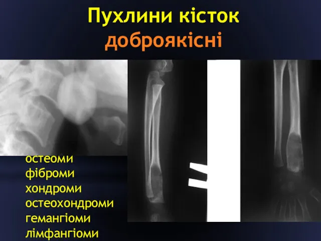 Пухлини кісток доброякісні остеоми фіброми хондроми остеохондроми гемангіоми лімфангіоми