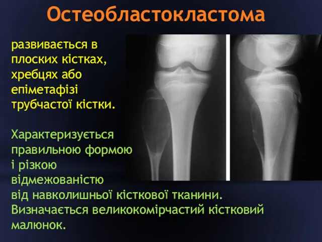 Остеобластокластома развивається в плоских кістках, хребцях або епіметафізі трубчастої кістки. Характеризується правильною формою