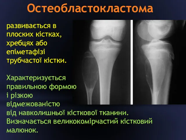 Остеобластокластома развивається в плоских кістках, хребцях або епіметафізі трубчастої кістки.