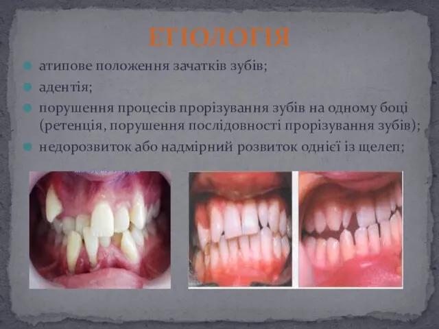 атипове положення зачатків зубів; адентія; порушення процесів прорізування зубів на
