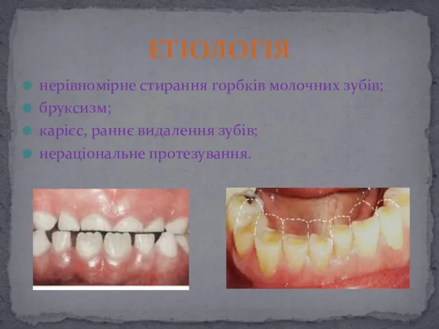 нерівномірне стирання гoрбків молочних зубів; бруксизм; кapiєc, pаннє видалення зубів; нераціональне протезування. ЕТІОЛОГІЯ