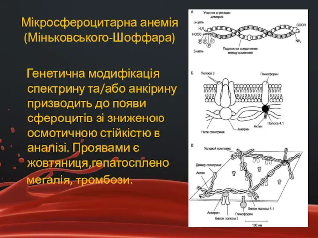 Мікросфероцитарна анемія (Міньковського-Шоффара) Генетична модифікація спектрину та/або анкірину призводить до