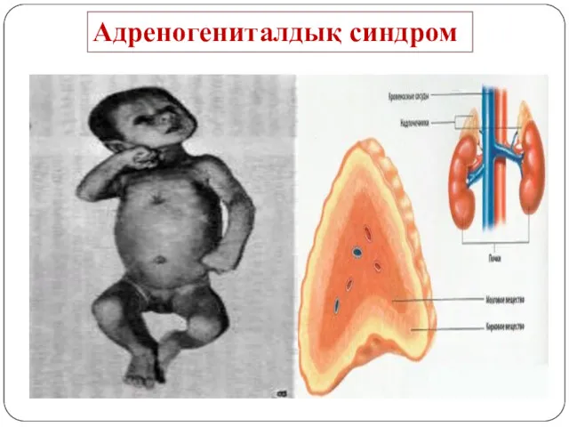 Адреногениталдық синдром