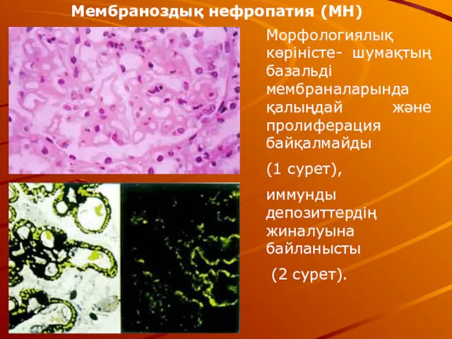 Мембраноздық нефропатия (МН) Морфологиялық көріністе- шумақтың базальді мембраналарында қалыңдай және