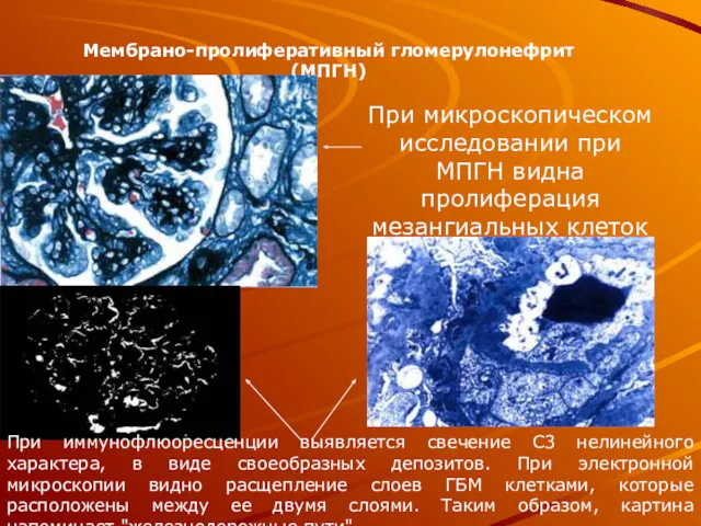 Мембрано-пролиферативный гломерулонефрит (МПГН) При микроскопическом исследовании при МПГН видна пролиферация