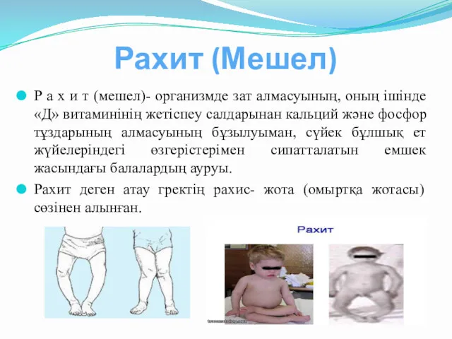 Рахит (Мешел) Р а х и т (мешел)- организмде зат