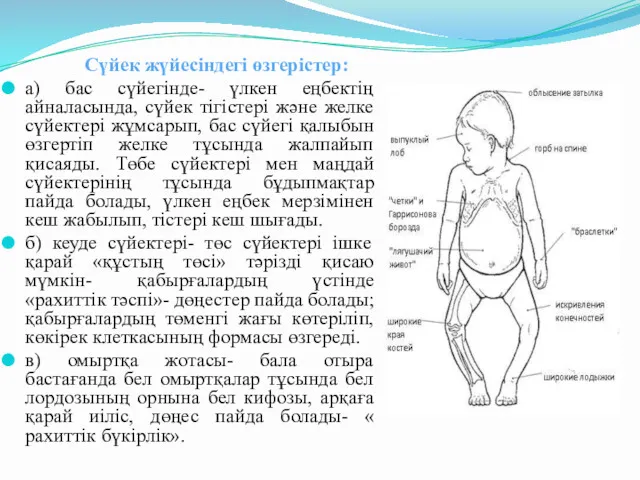 Сүйек жүйесіндегі өзгерістер: а) бас сүйегінде- үлкен еңбектің айналасында, сүйек тігістері және желке