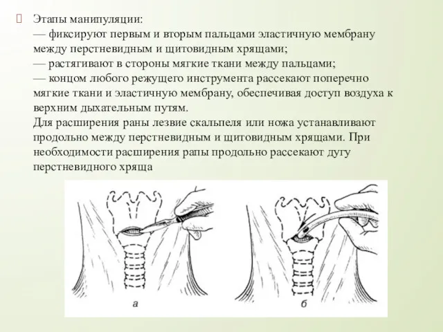 Этапы манипуляции: — фиксируют первым и вторым пальцами эластичную мембрану