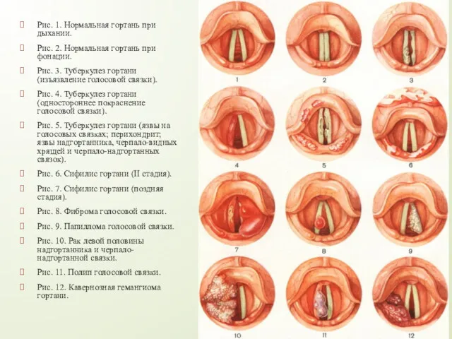 Рис. 1. Нормальная гортань при дыхании. Рис. 2. Нормальная гортань