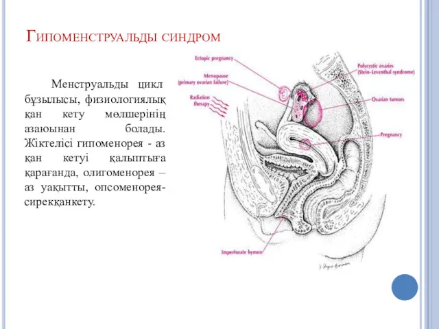 Гипоменструальды синдром Менструальды цикл бұзылысы, физиологиялық қан кету мөлшерінің азаюынан