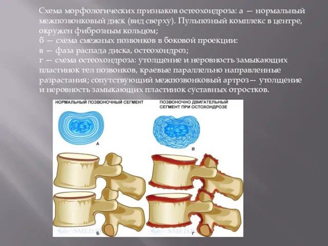 Схема морфологических признаков остеохондроза: а — нормальный межпозвонковый диск (вид