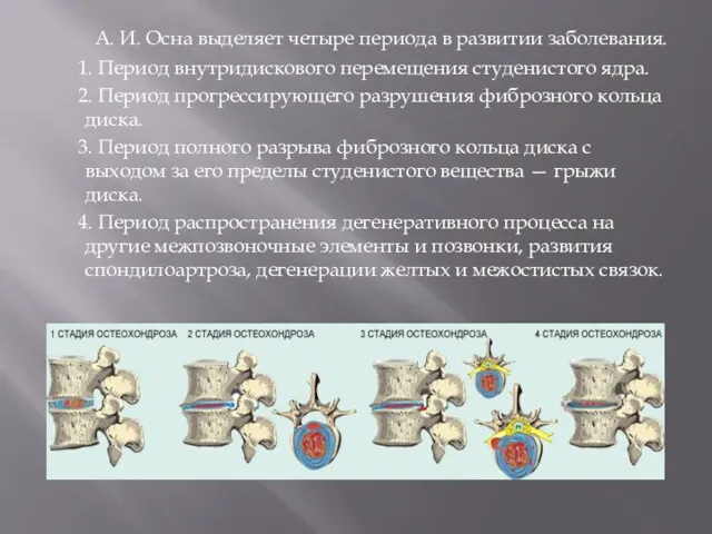 А. И. Осна выделяет четыре периода в развитии заболевания. 1.