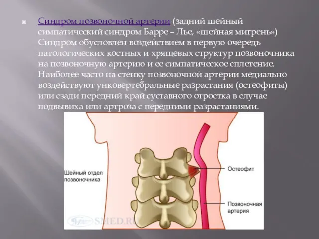 Синдром позвоночной артерии (задний шейный симпатический синдром Барре – Лье,