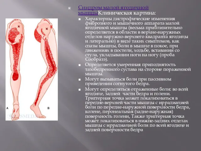 Синдром малой ягодичной мышцыКлиническая картина: Характерны дистрофические изменения фиброзного и