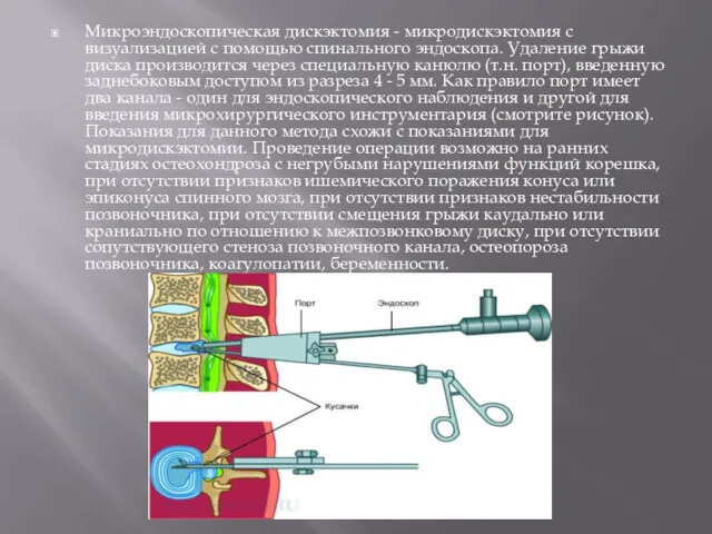 Микроэндоскопическая дискэктомия - микродискэктомия с визуализацией с помощью спинального эндоскопа.