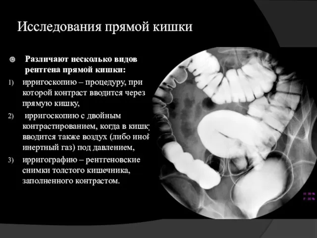 Исследования прямой кишки Различают несколько видов рентгена прямой кишки: ирригоскопию