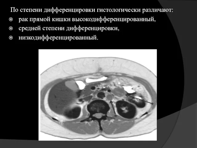 По степени дифференцировки гистологически различают: рак прямой кишки высокодифференцированный, средней степени дифференцировки, низкодифференцированный.