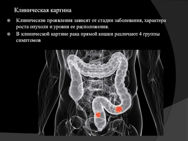 Клиническая картина Клинические проявления зависят от стадии заболевания, характера роста