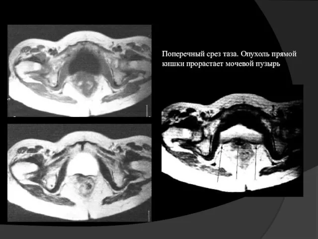 Поперечный срез таза. Опухоль прямой кишки прорастает мочевой пузырь