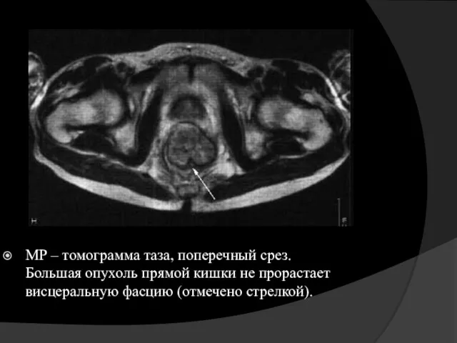 МР – томограмма таза, поперечный срез. Большая опухоль прямой кишки не прорастает висцеральную фасцию (отмечено стрелкой).