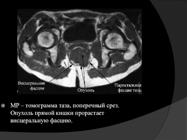 МР – томограмма таза, поперечный срез. Опухоль прямой кишки прорастает висцеральную фасцию.