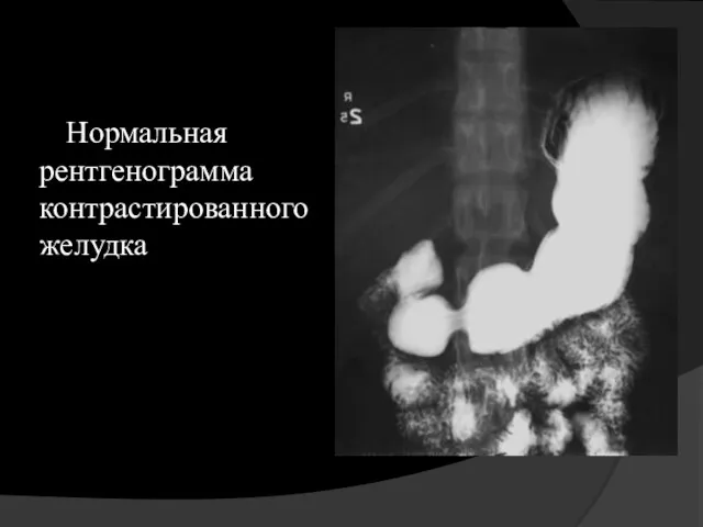 Нормальная рентгенограмма контрастированного желудка