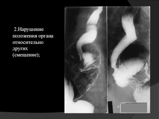 2.Нарушение положения органа относительно других (смещение);