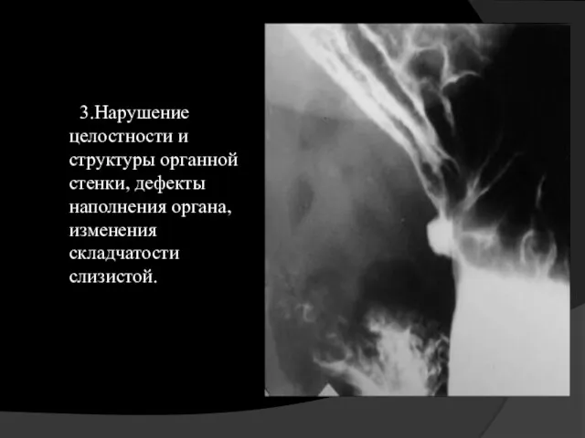 3.Нарушение целостности и структуры органной стенки, дефекты наполнения органа, изменения складчатости слизистой.