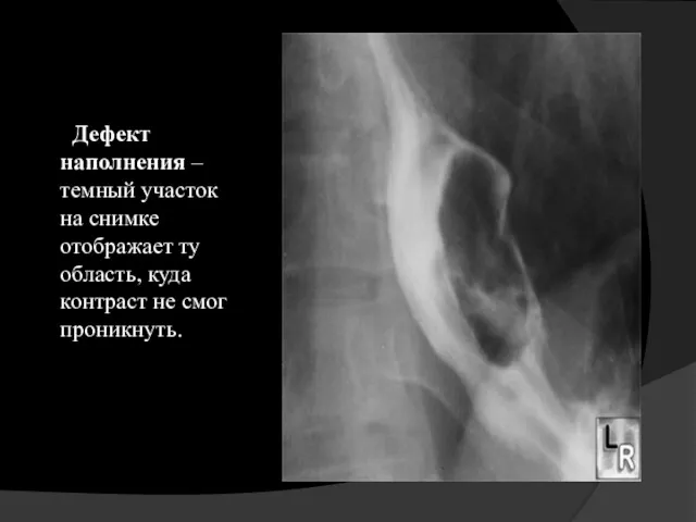 Дефект наполнения – темный участок на снимке отображает ту область, куда контраст не смог проникнуть.