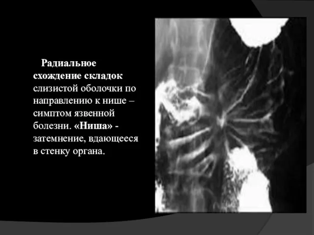 Радиальное схождение складок слизистой оболочки по направлению к нише –