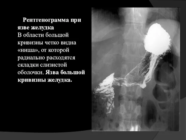 Рентгенограмма при язве желудка В области большой кривизны четко видна