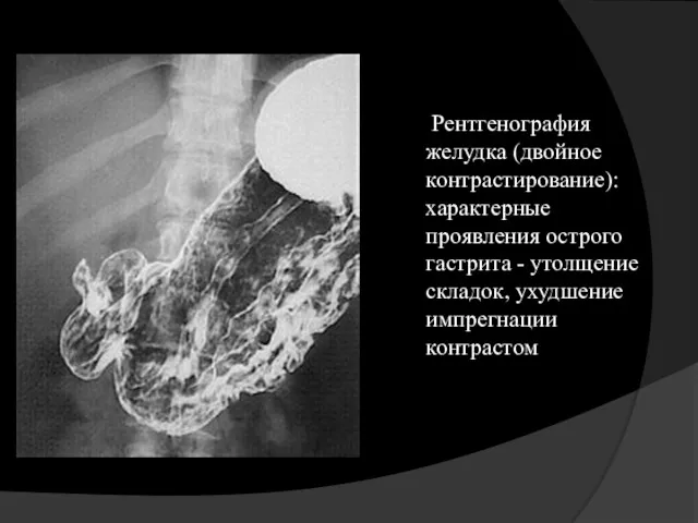 Рентгенография желудка (двойное контрастирование): характерные проявления острого гастрита - утолщение складок, ухудшение импрегнации контрастом