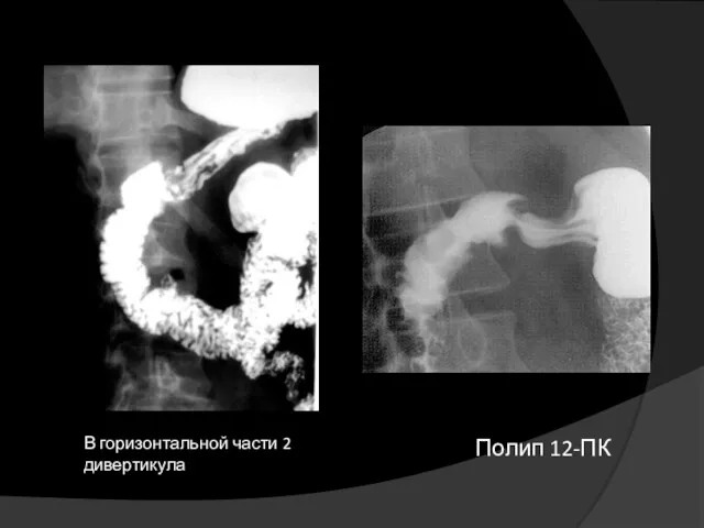 Синдром расширения пищеварительного канала Полип 12-ПК В горизонтальной части 2 дивертикула
