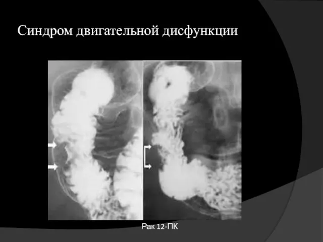 Синдром двигательной дисфункции Рак 12-ПК