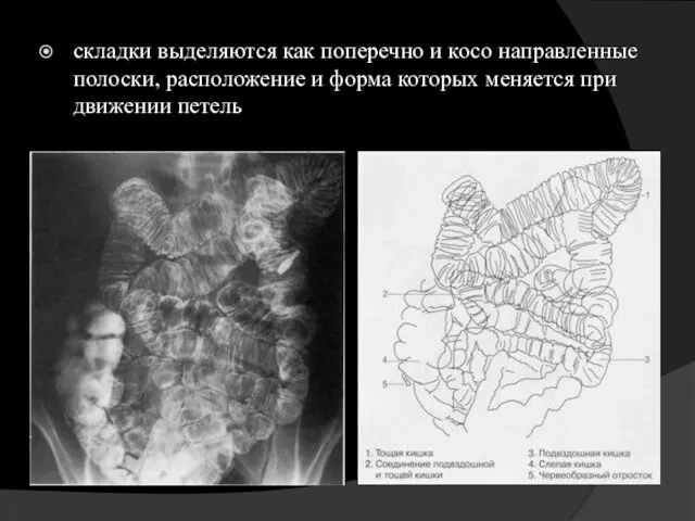 складки выделяются как поперечно и косо направленные полоски, расположение и форма которых меняется при движении петель