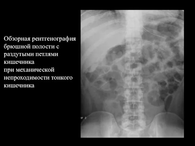 Обзорная рентгенография брюшной полости с раздутыми петлями кишечника при механической непроходимости тонкого кишечника