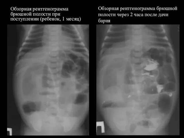 Обзорная рентгенограмма брюшной полости при поступлении (ребенок, 1 месяц) Обзорная