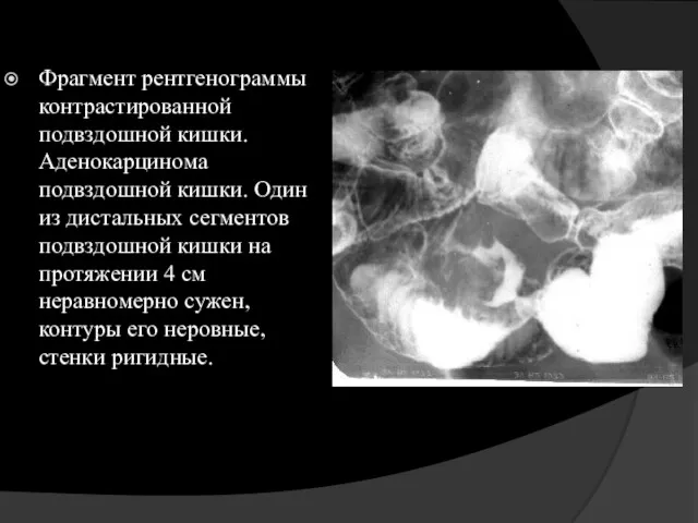 Фрагмент рентгенограммы контрастированной подвздошной кишки. Аденокарцинома подвздошной кишки. Один из