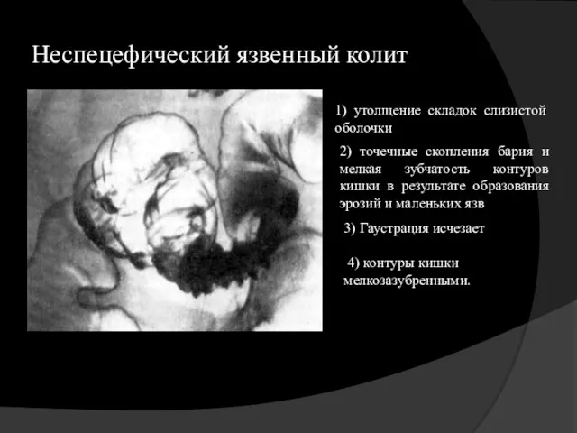 Неспецефический язвенный колит 1) утолщение складок слизистой оболочки 2) точечные