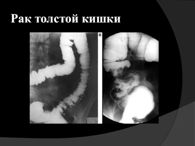 Рак толстой кишки