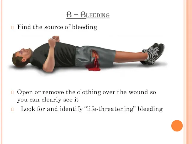 B – Bleeding Find the source of bleeding Open or