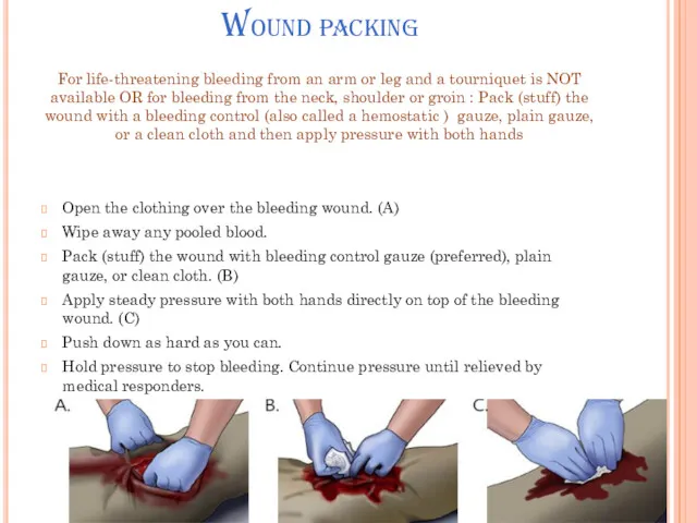 Wound packing For life-threatening bleeding from an arm or leg